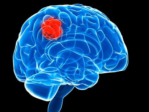 Glioblastoma Alters Synaptic Function to Promote Tumor Growth