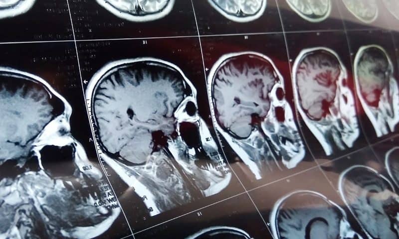 Canon Medical expands reach of its MRI artificial intelligence programs