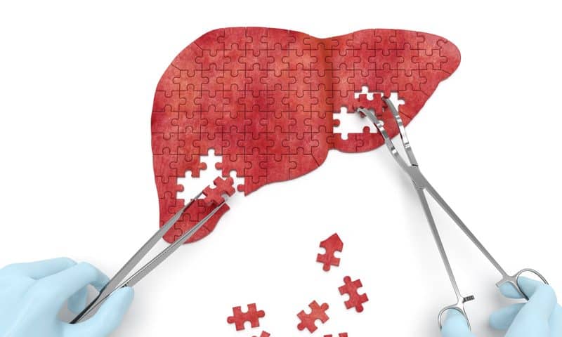 Perspectum’s liver-scanning software scores FDA clearance for planning cancer surgeries