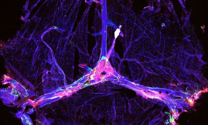 Could unclogging the brain’s drainage system improve the efficacy of Biogen’s aducanumab in Alzheimer’s?