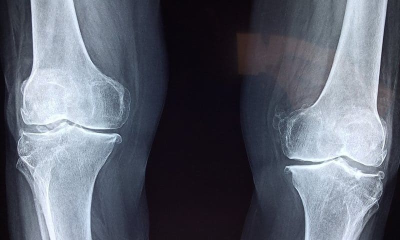 Bone Therapeutics’ lead program falls short in knee osteoarthritis