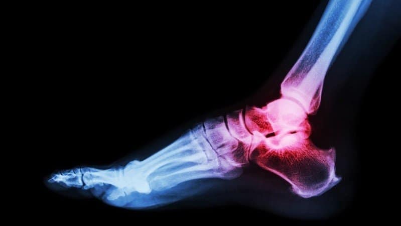 At the CrossRoads: J&J’s DePuy Synthes acquires foot and ankle implant system maker￼