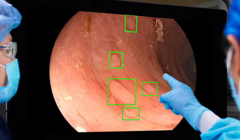 Medtronic’s colonoscopy AI cuts number of missed polyps in half, study finds￼