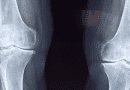 FDA approves Orthofix’s ultrasonic bone fracture healing system￼
