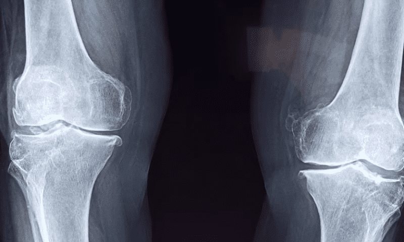 FDA approves Orthofix’s ultrasonic bone fracture healing system￼