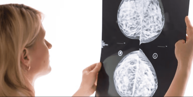 iCAD’s 3D mammography AI catches more breast cancers in real-world study