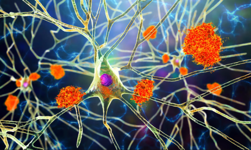 Plaque to basics: New research hints Alzheimer’s treatments may be looking in the wrong place￼