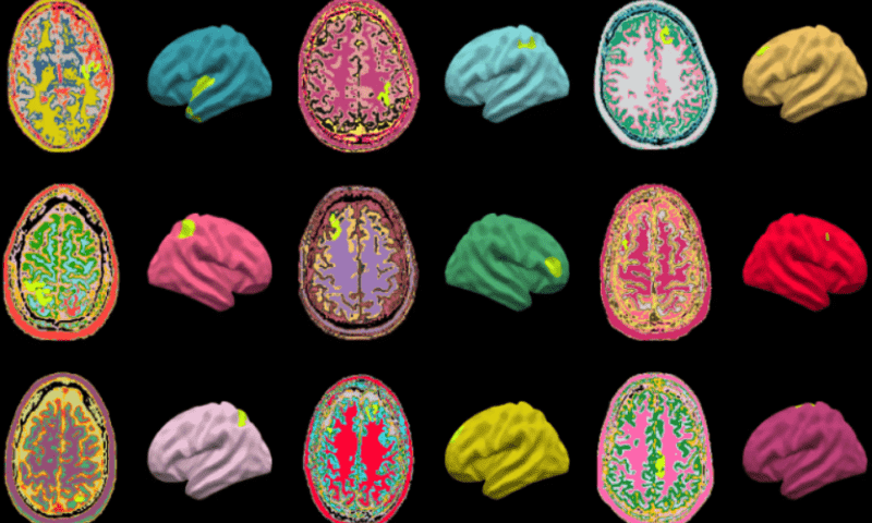 MRI-reading AI homes in on the brain abnormalities that cause drug-resistant epilepsy