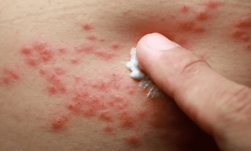 VC firm LifeArc sells first portfolio company as dermatitis-focused Ducentis bought by Arcutis for $30M