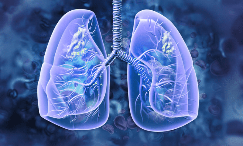 Intuitive joins $14M funding for lung cancer AI developer Optellum