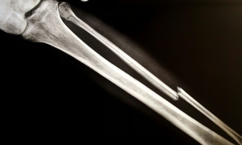 University of Utah’s Bone Bolt system for complex fractures earns FDA clearance