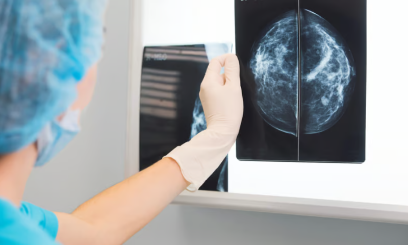 Mammogram AI shows more promise, performing as well as radiologists in breast cancer screening study
