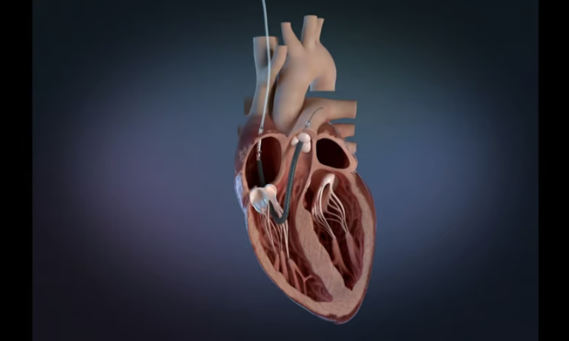 J&J’s Abiomed updates labeling for certain Impella heart pumps in Class I safety event