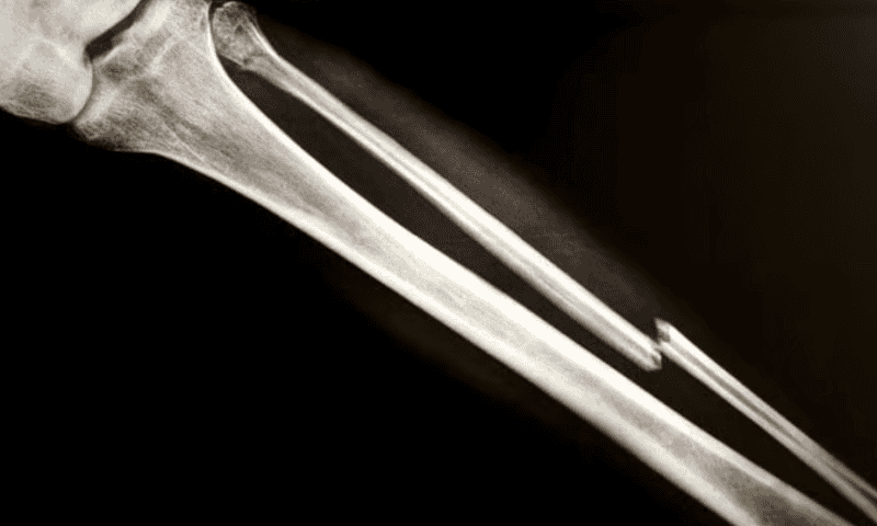 Ultragenyx and Mereo’s genetic bone disease treatment cuts fractures by 67%