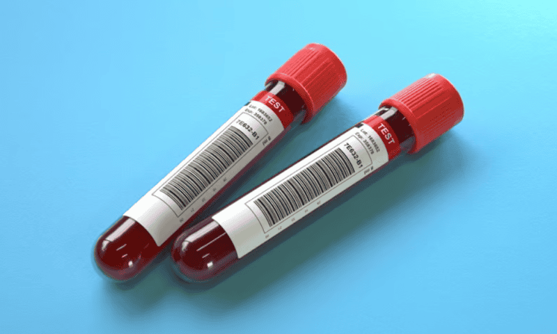 Study shows a front-line Alzheimer’s blood test could be as accurate as spinal fluid exams