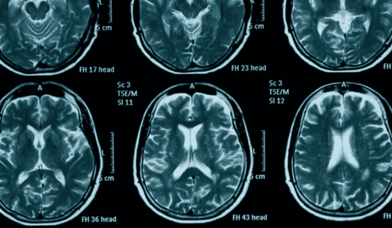 GSK, Sanofi, Denali take part in FNIH Parkinson’s biomarker project