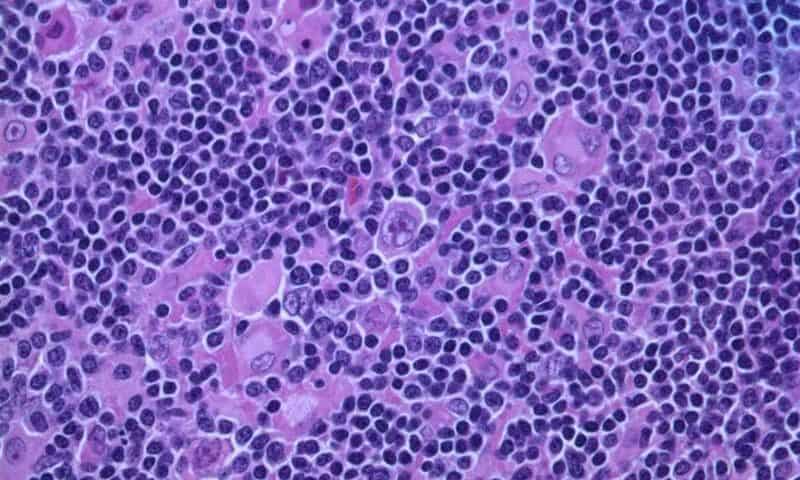 Lymphoma itself, not just treatment, can trigger rapid immune system and tissue aging