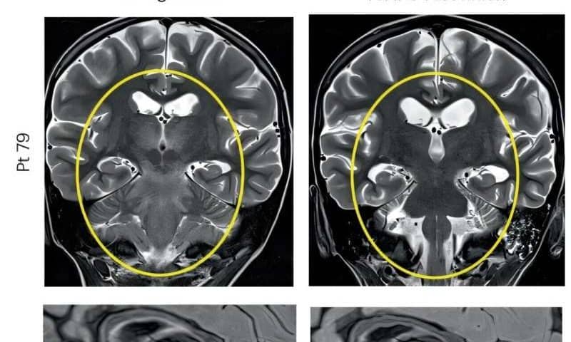GD2 CAR T treatment induces durable remissions in high-risk neuroblastoma