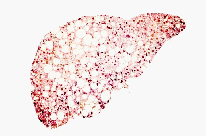 High-Fat Diet Triggers Hepatocyte Dedifferentiation and Cancer Risk
