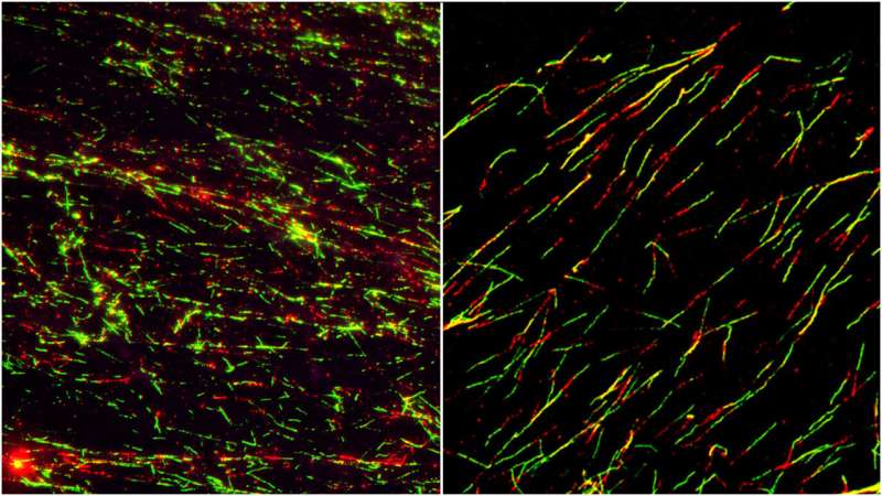 Rb1 identified as predictive biomarker for new therapeutic strategy in some breast cancers