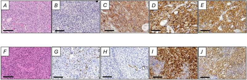 An oral cancer drug shows promise against aggressive brain tumors