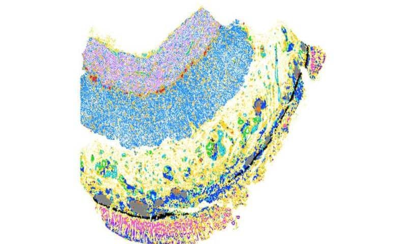 Researchers uncover molecular roots of tissue scarring in inflammatory bowel disease