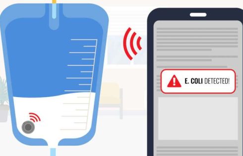 Smartphone-linked catheter sensor could spot UTIs sooner than lab cultures