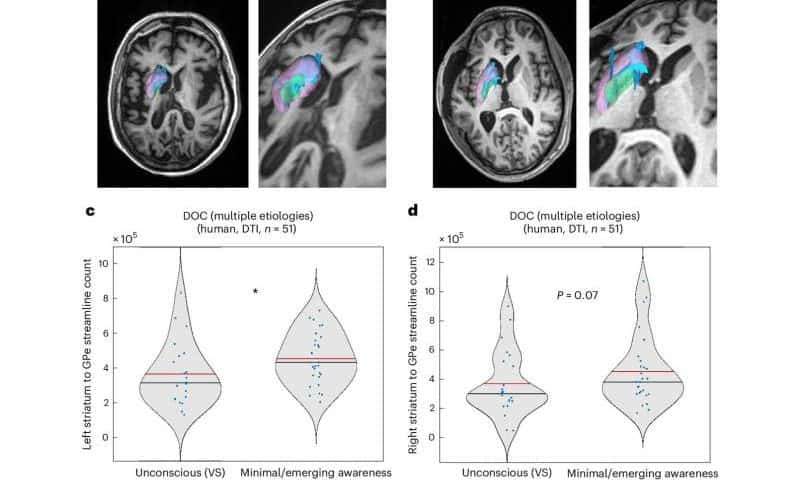 Adversarial AI framework reveals mechanisms behind impaired consciousness and a potential therapy