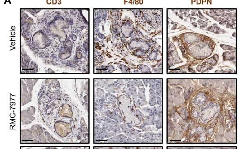 New strategy intercepts pancreatic cancer by eliminating microscopic lesions before they become cancer