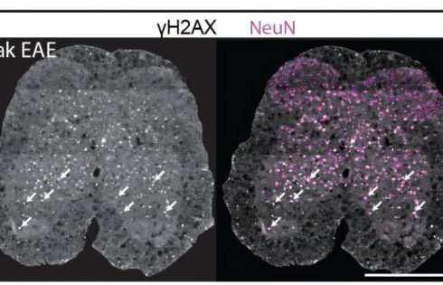 Parthanatos pathway behind neuron loss in multiple sclerosis identified