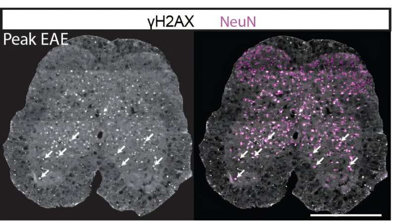 Parthanatos pathway behind neuron loss in multiple sclerosis identified
