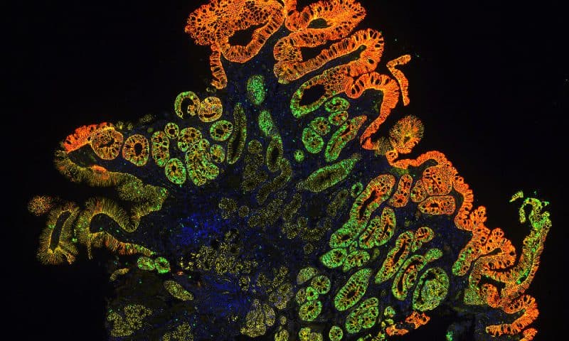 Spatial Biology Moves Cancer Research Forward