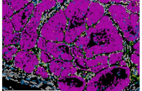 Within primary breast tumors, a high-risk cell state may seed future metastases