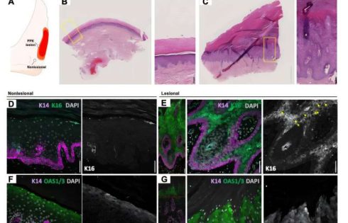 Skin protein K16 found to control inflammation in stressed skin