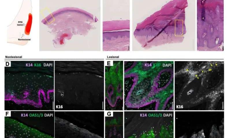 Skin protein K16 found to control inflammation in stressed skin