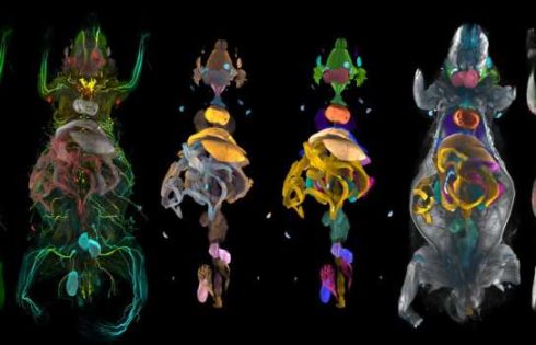 AI atlas reveals hidden whole-body-damage caused by obesity