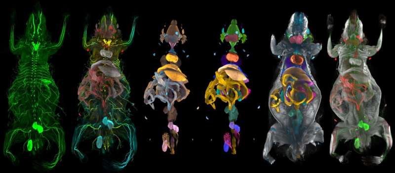 AI atlas reveals hidden whole-body-damage caused by obesity