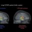 Brain inflammation is unlikely to explain persistent long COVID symptoms, neuroimaging study finds