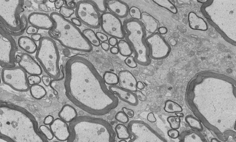 Two drug strategies boost myelin repair in MS models, cutting neuroinflammation