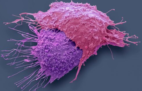 Targeting Metabolic Mechanism Restores Chemotherapy Sensitivity in Ovarian Cancer