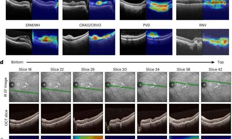 New AI tools could help eye doctors diagnose retinal disease faster